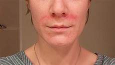Blemish Soap