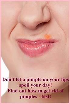 Blemish Soap