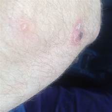 Blister Soaps