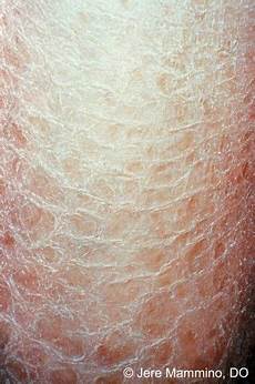 Dermatological Soap