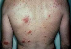 Eczema Soap