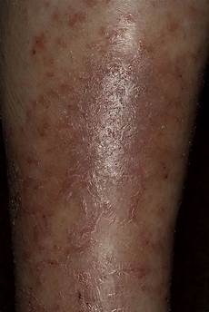 Eczema Soap